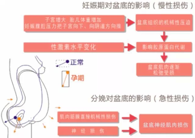 女性盆底功能障碍性疾病介绍