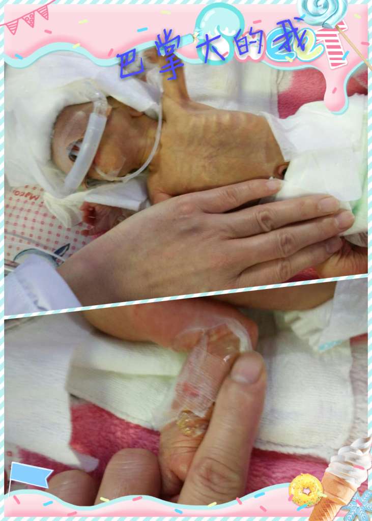 有爱,有未来——"巴掌婴儿"把爱带回家